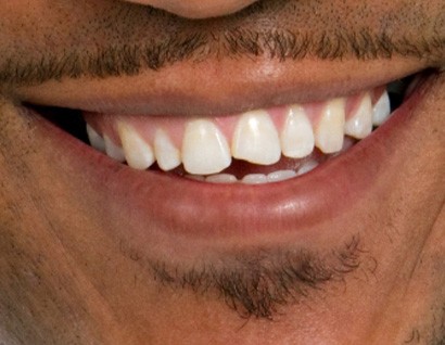 person with chipped tooth